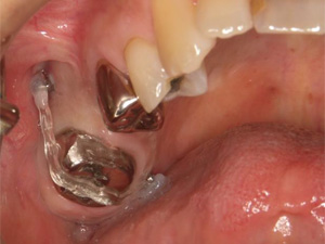 矯正用アンカースクリュー