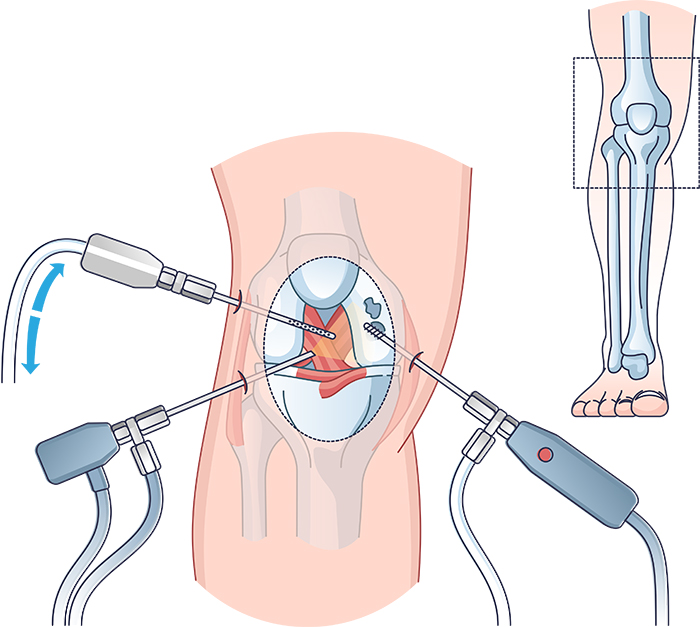 膝関節鏡下手術とは・・・どんな手術？ | 札幌いがらし人工関節クリニック