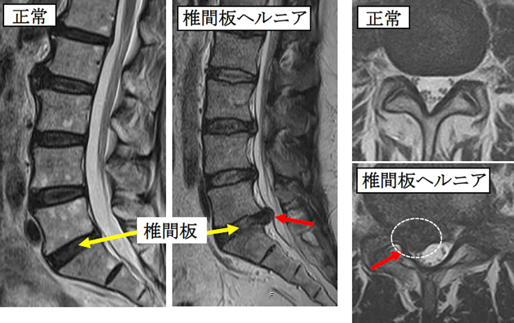 脊椎脊髄疾患について | 東京脊椎脊髄病センター | 苑田第三病院
