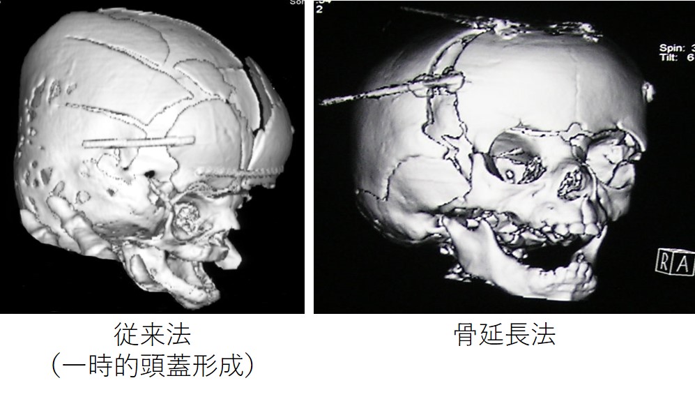 Neuroinfo Japan：頭蓋骨縫合早期癒合