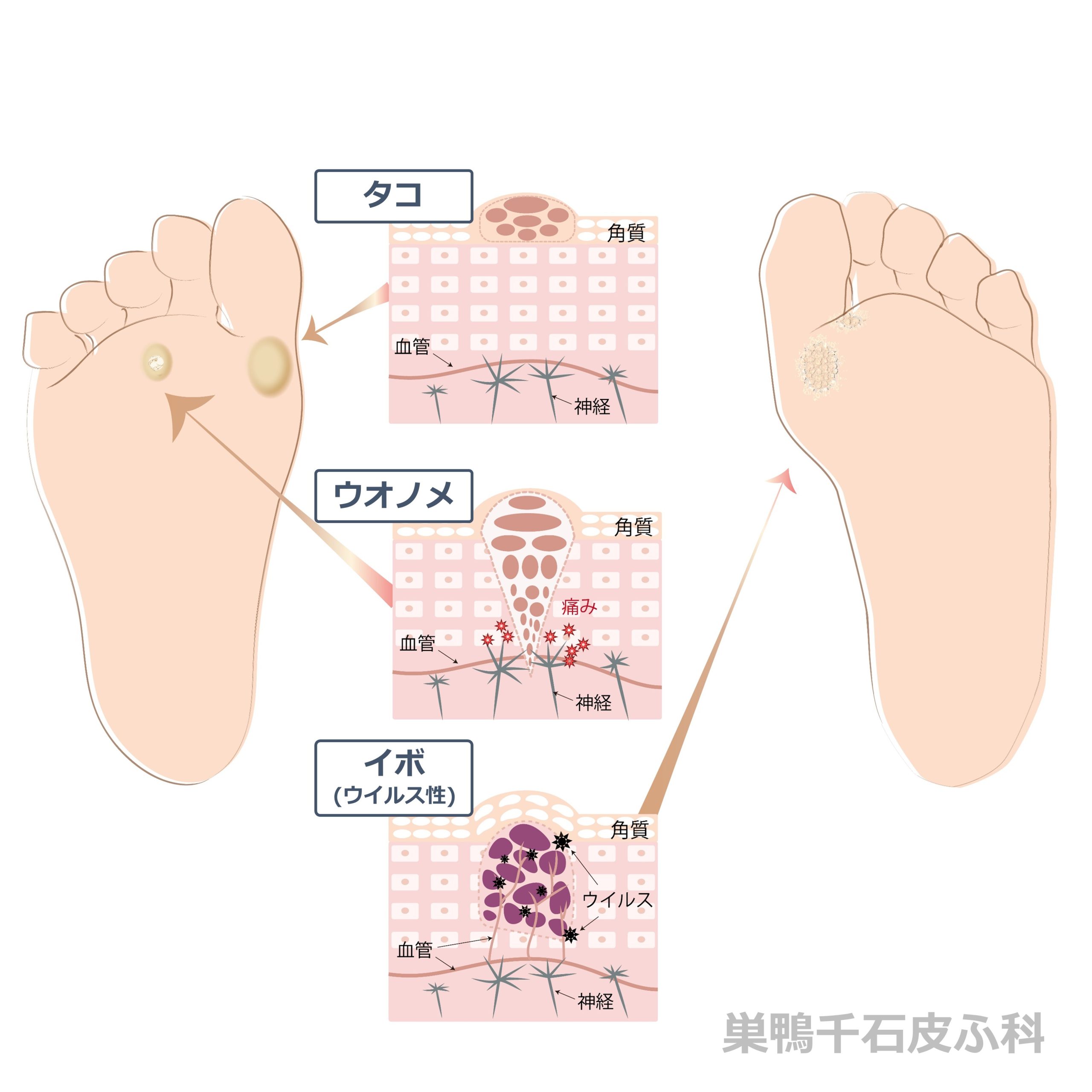 いぼ（尋常性疣贅） - 巣鴨千石皮ふ科