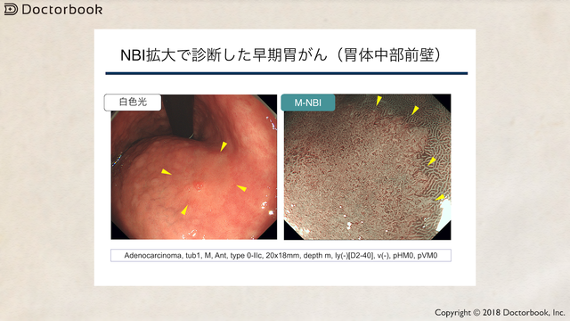 医師出演】NBI・BLIによる胃がんの拡大内視鏡診断とは？ | Doctorbook