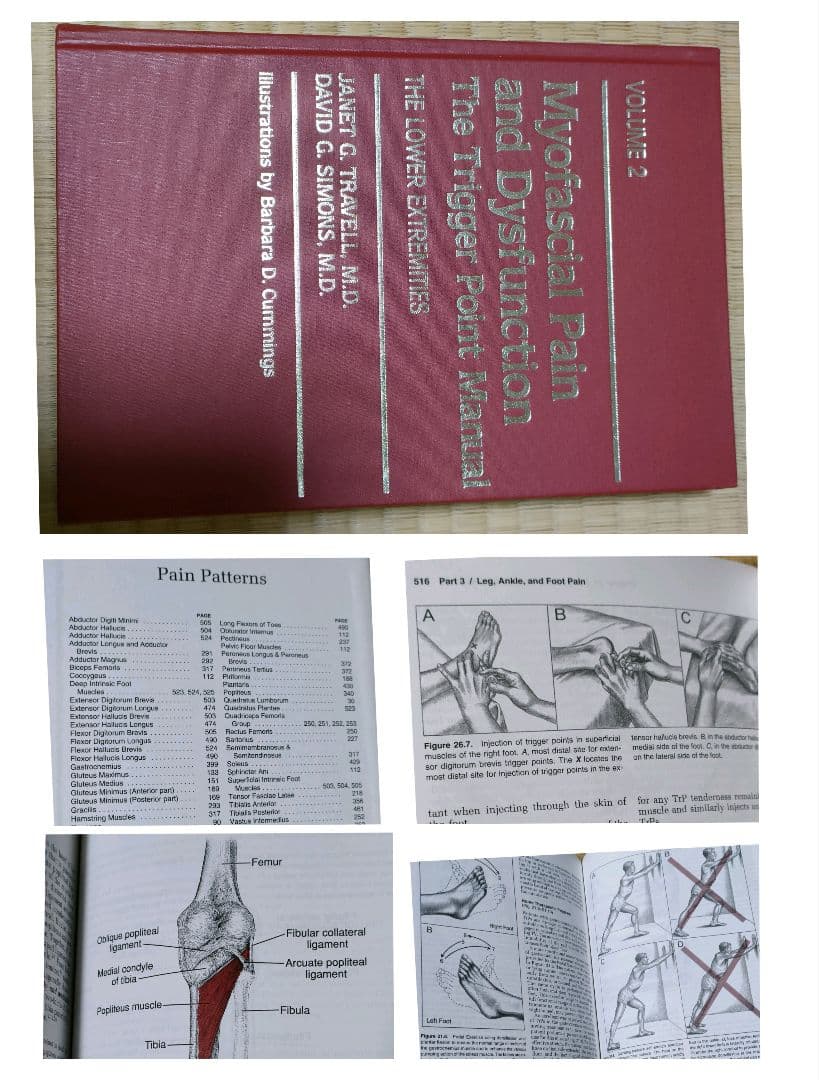 英語版　筋膜痛　筋膜機能障害 トリガーポイント　筋膜性疼痛　下半身 筋筋膜性疼痛症候群【MPS】痛みの引き金トリガーポイント｜痛みの事